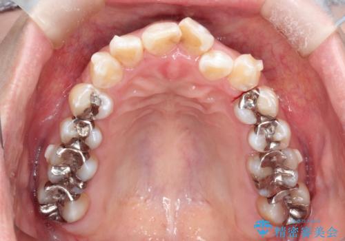 前歯のガタつきをマウスピース矯正で改善! 驚きの効果を体験しようの治療中