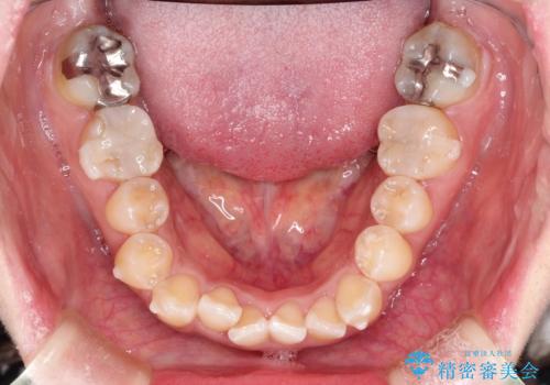 前歯のガタつきをマウスピース矯正で改善!　驚きの効果を体験しようの治療中