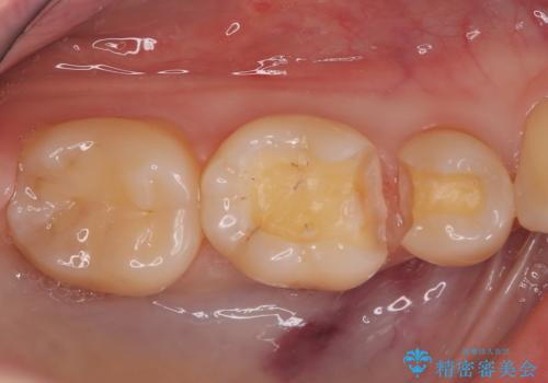 【ハイブリッドインレー】銀歯を白くしたい の治療中