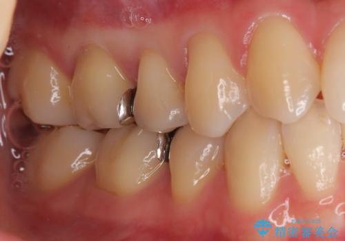 【ハイブリッドインレー】銀歯を白くしたい の治療前