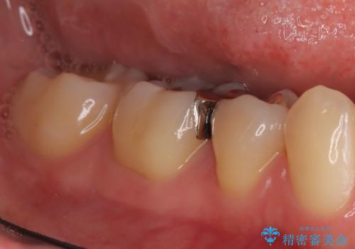 【ハイブリッドインレー】銀歯を白くしたい の治療前