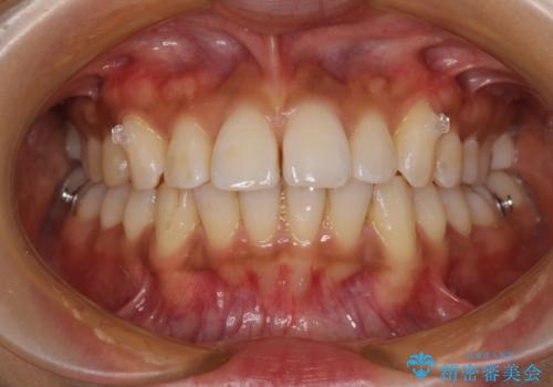 カリエール・ディスタライザーを併用したインビザライン矯正治療の治療中