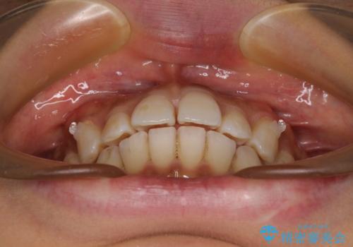 カリエール・ディスタライザーを併用したインビザライン矯正治療の治療中