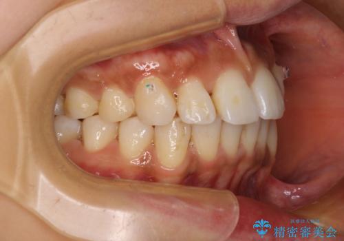カリエール・ディスタライザーを併用したインビザライン矯正治療の治療中