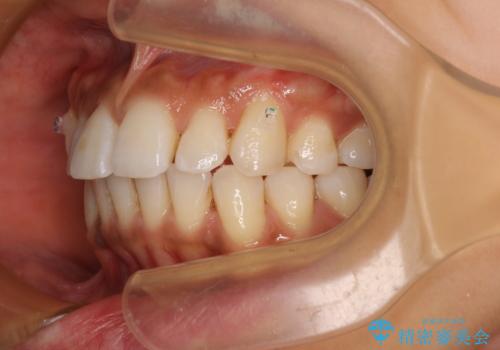 カリエール・ディスタライザーを併用したインビザライン矯正治療の治療中