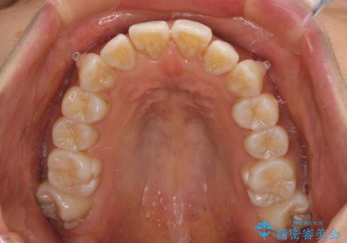 カリエール・ディスタライザーを併用したインビザライン矯正治療の治療中