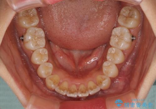 カリエール・ディスタライザーを併用したインビザライン矯正治療の治療中