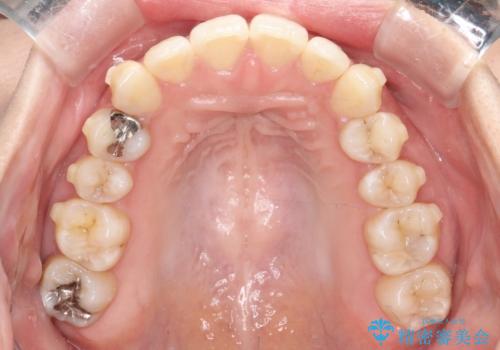 驚くほど短期間で前歯のガタツキを解消! マウスピース矯正の効果の治療中