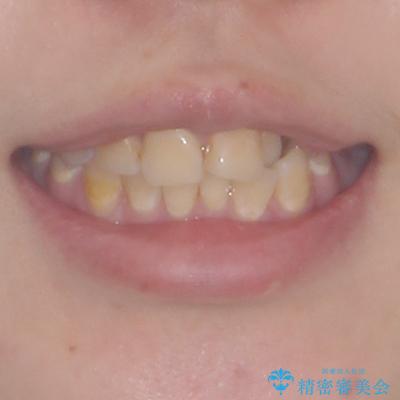 前歯のクロスバイトを改善 ワイヤー矯正を併用したインビザライン矯正の治療前(顔貌)