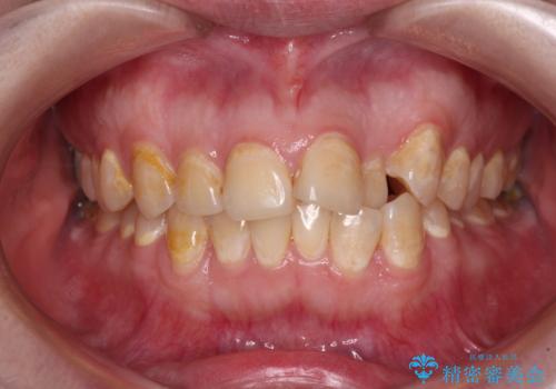 前歯のクロスバイトを改善　ワイヤー矯正を併用したインビザライン矯正の症例 治療前