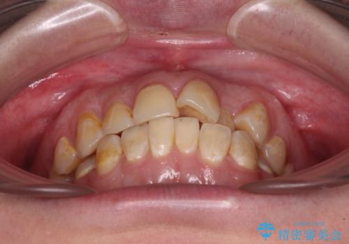 前歯のクロスバイトを改善 ワイヤー矯正を併用したインビザライン矯正の治療前