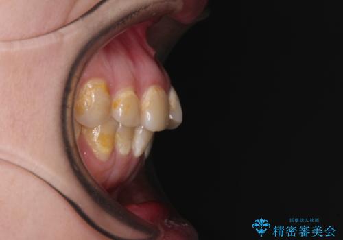 前歯のクロスバイトを改善 ワイヤー矯正を併用したインビザライン矯正の治療前