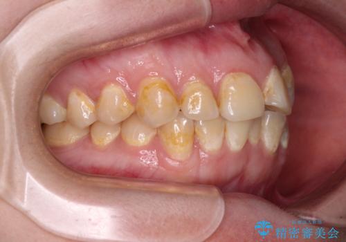 前歯のクロスバイトを改善 ワイヤー矯正を併用したインビザライン矯正の治療前