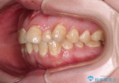 前歯のクロスバイトを改善 ワイヤー矯正を併用したインビザライン矯正の治療前