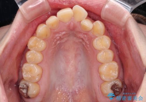 前歯のクロスバイトを改善　ワイヤー矯正を併用したインビザライン矯正の治療前
