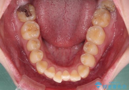 前歯のクロスバイトを改善 ワイヤー矯正を併用したインビザライン矯正の治療前