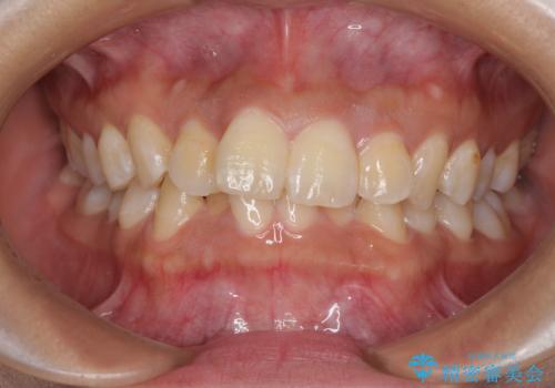 前歯のデコボコと隠れてしまう下顎前歯 インビザラインですっきりと改善の治療前