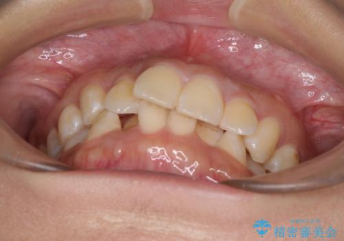 前歯のデコボコと隠れてしまう下顎前歯 インビザラインですっきりと改善の治療前