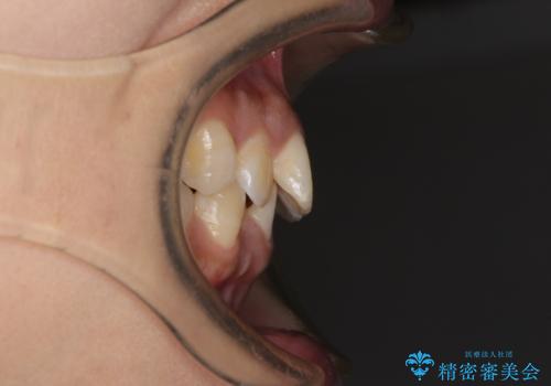 前歯のデコボコと隠れてしまう下顎前歯 インビザラインですっきりと改善の治療前