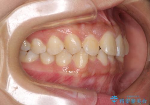 前歯のデコボコと隠れてしまう下顎前歯 インビザラインですっきりと改善の治療前