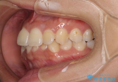 前歯のデコボコと隠れてしまう下顎前歯 インビザラインですっきりと改善の治療前