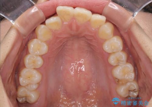 前歯のデコボコと隠れてしまう下顎前歯　インビザラインですっきりと改善の治療前