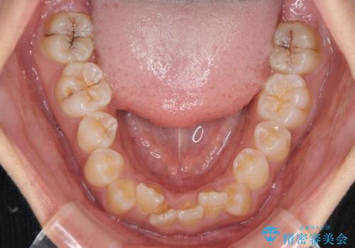 前歯のデコボコと隠れてしまう下顎前歯 インビザラインですっきりと改善の治療前