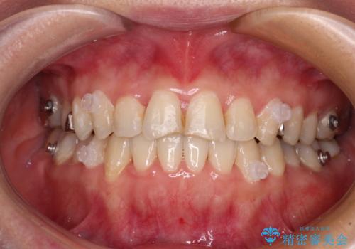 気になる歯列不正とむし歯を治療　インビザライン治療と虫歯治療の治療中