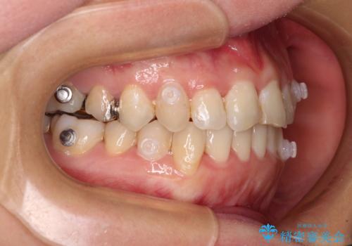 気になる歯列不正とむし歯を治療 インビザライン治療と虫歯治療の治療中