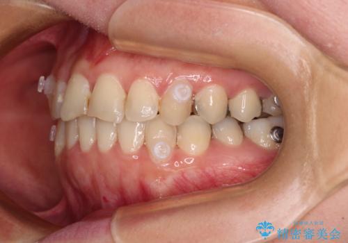 気になる歯列不正とむし歯を治療　インビザライン治療と虫歯治療の治療中