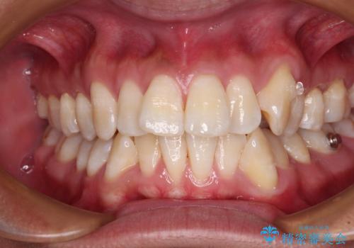 補助装置を併用してスムーズに インビザラインによる矯正治療の治療中