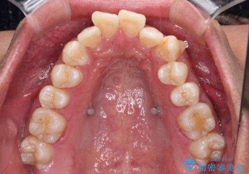 補助装置を併用してスムーズに インビザラインによる矯正治療の治療中