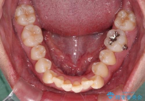 補助装置を併用してスムーズに インビザラインによる矯正治療の治療中