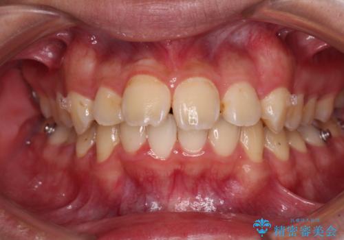 【モニター】飛び出した上の前歯 ワイヤー装置を併用してインビザラインできれいにの治療中