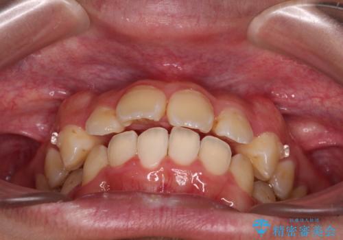 【モニター】飛び出した上の前歯 ワイヤー装置を併用してインビザラインできれいにの治療中