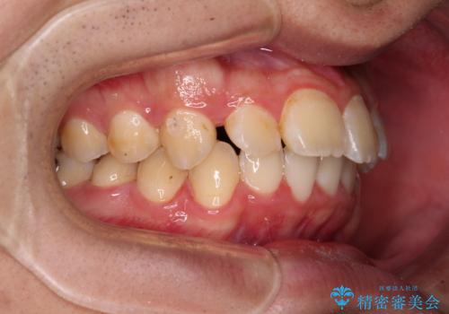 【モニター】飛び出した上の前歯 ワイヤー装置を併用してインビザラインできれいにの治療中