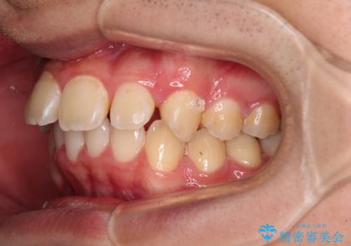 【モニター】飛び出した上の前歯 ワイヤー装置を併用してインビザラインできれいにの治療中