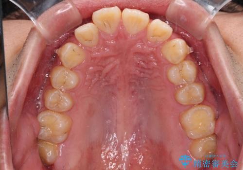 【モニター】飛び出した上の前歯 ワイヤー装置を併用してインビザラインできれいにの治療中