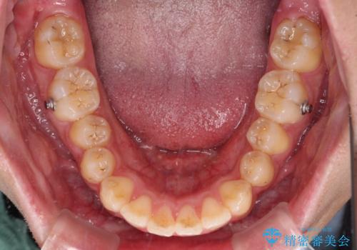 【モニター】飛び出した上の前歯 ワイヤー装置を併用してインビザラインできれいにの治療中