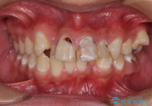 前歯のデコボコとむし歯だらけの歯列　矯正治療と虫歯治療の治療前