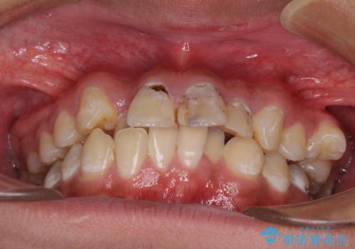 前歯のデコボコとむし歯だらけの歯列 矯正治療と虫歯治療の治療前