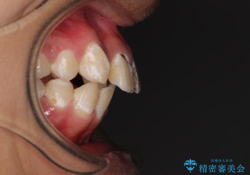 前歯のデコボコとむし歯だらけの歯列 矯正治療と虫歯治療の治療前