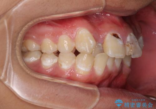 前歯のデコボコとむし歯だらけの歯列 矯正治療と虫歯治療の治療前