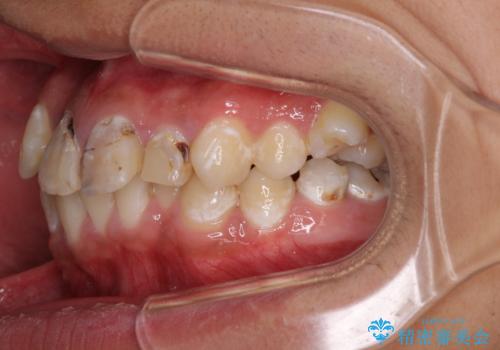 前歯のデコボコとむし歯だらけの歯列 矯正治療と虫歯治療の治療前