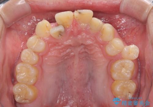 前歯のデコボコとむし歯だらけの歯列 矯正治療と虫歯治療の治療前