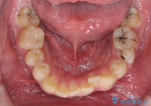 前歯のデコボコとむし歯だらけの歯列 矯正治療と虫歯治療の治療前