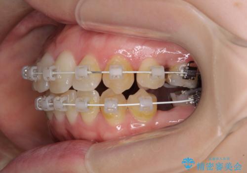 大きなむし歯の奥歯を抜歯してスペースを活用　ワイヤー装置による抜歯矯正の治療中