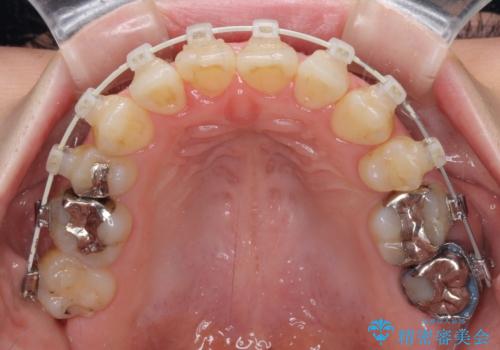 大きなむし歯の奥歯を抜歯してスペースを活用　ワイヤー装置による抜歯矯正の治療中