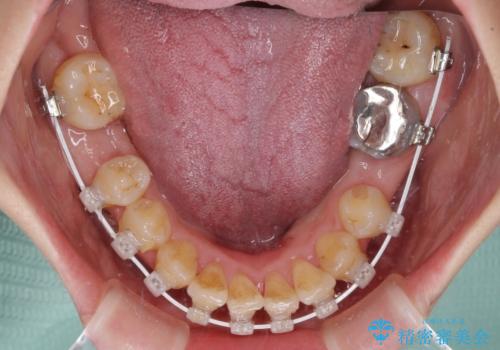 大きなむし歯の奥歯を抜歯してスペースを活用　ワイヤー装置による抜歯矯正の治療中