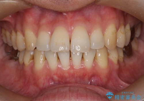 短期間で口元の印象をガラリと変えませんか? 30代男性 インビザライン矯正で自然な口元美を実現の治療中